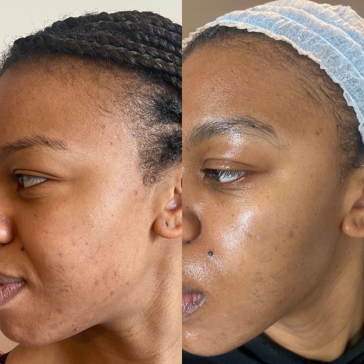 Before and after skin transformation