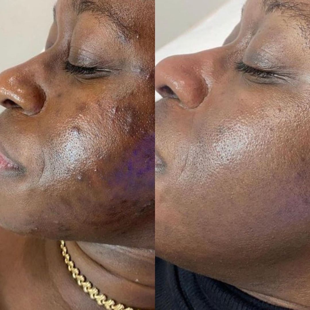 Before and after skin transformation