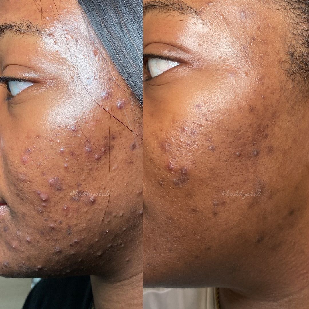 Before and after skin transformation