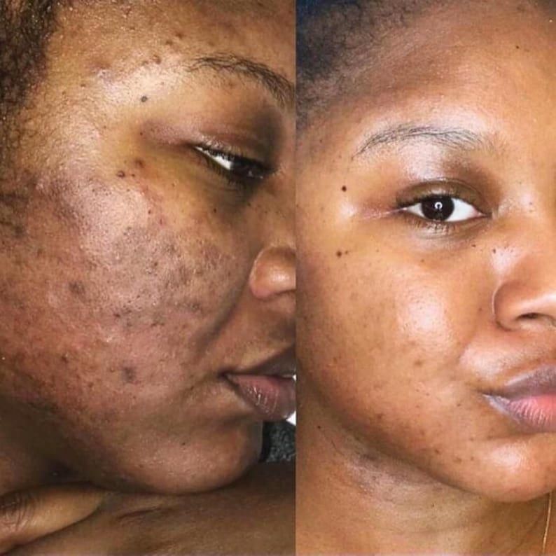 Before and after skin transformation